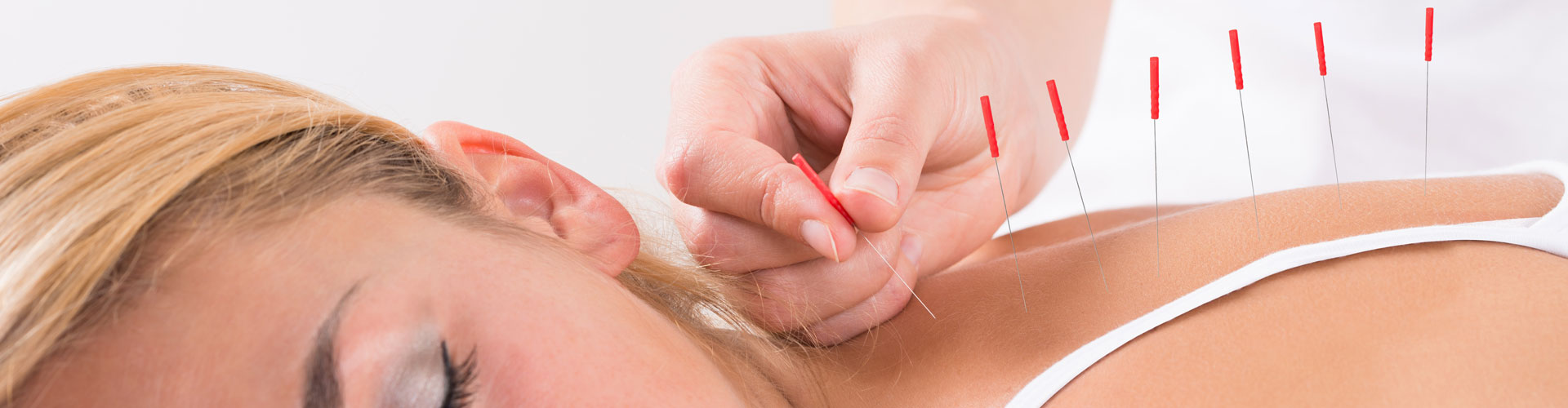 Mujer recibiendo tratamiento de Acupuntura