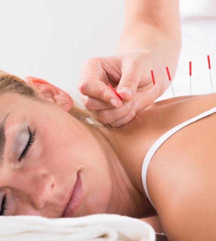 Mujer recibiendo tratamiento de Acupuntura